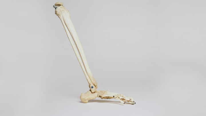 Jałowa martwica kości